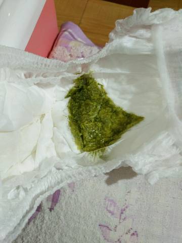 供卵试管宝宝拉绿屎是什么原因